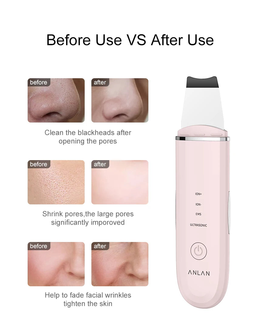 ANLAN Ultrasonic Skin Scrubber - Deep Cleaning Peeling Shovel for Facial Care and Skin Lifting - Ultrasonic Cleaner for Radiant Skin - Limetastore